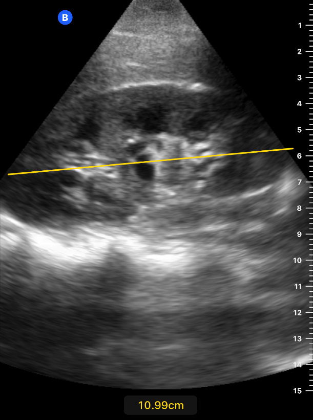 Renal — Ultra Sono